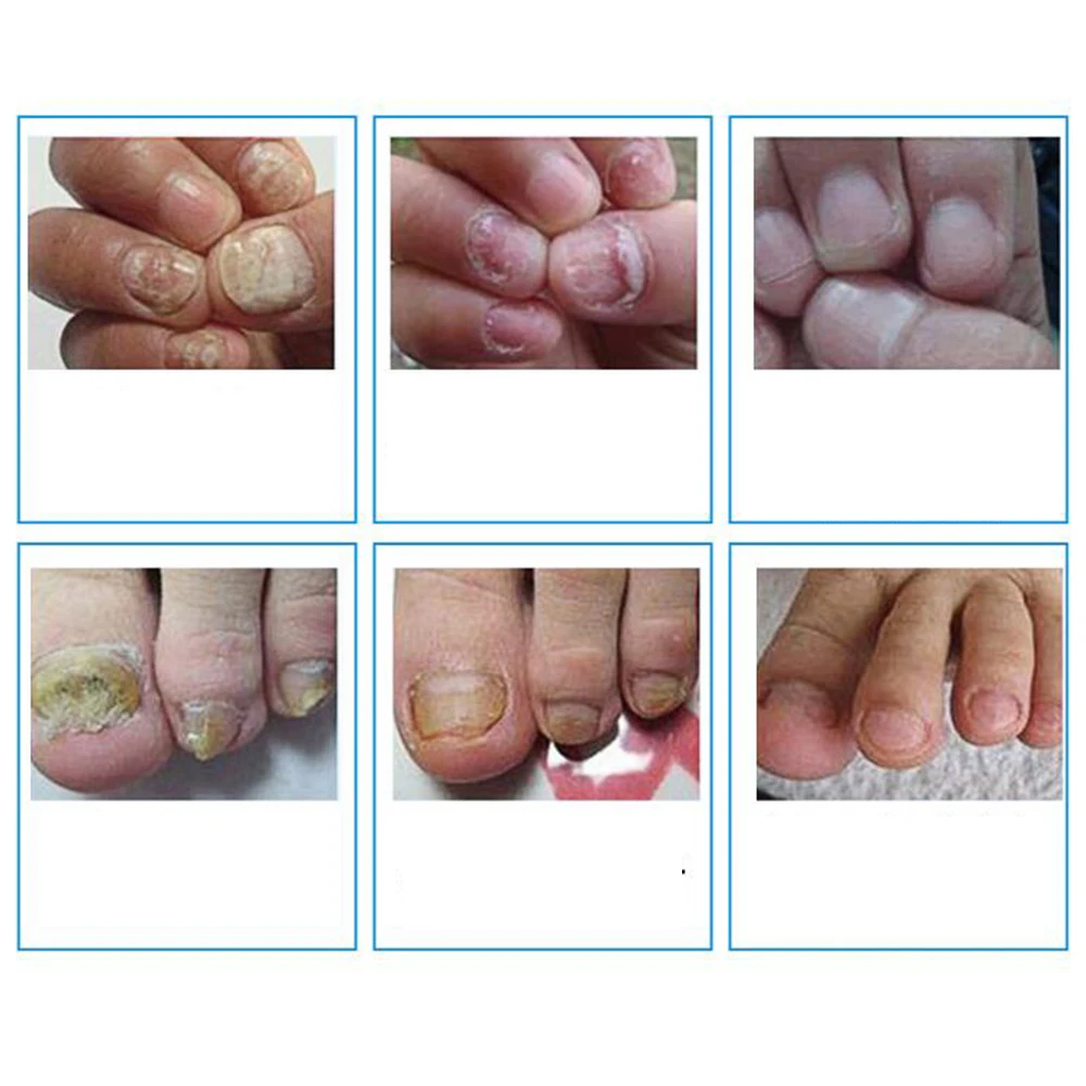 ciuperca sigiliu unghii Este posibil să tratați ciuperca unghiilor cu fucorcină?
