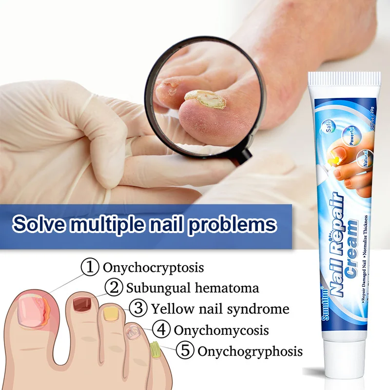 medicament pentru prevenirea ciupercilor unghiilor de la picioare