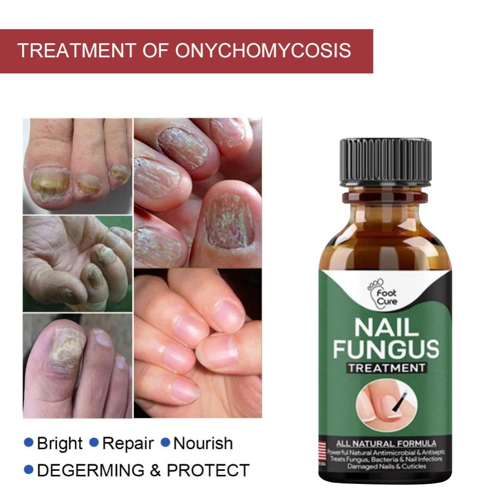 simptome ale ciupercii degetelor de la picioare și ale unghiilor